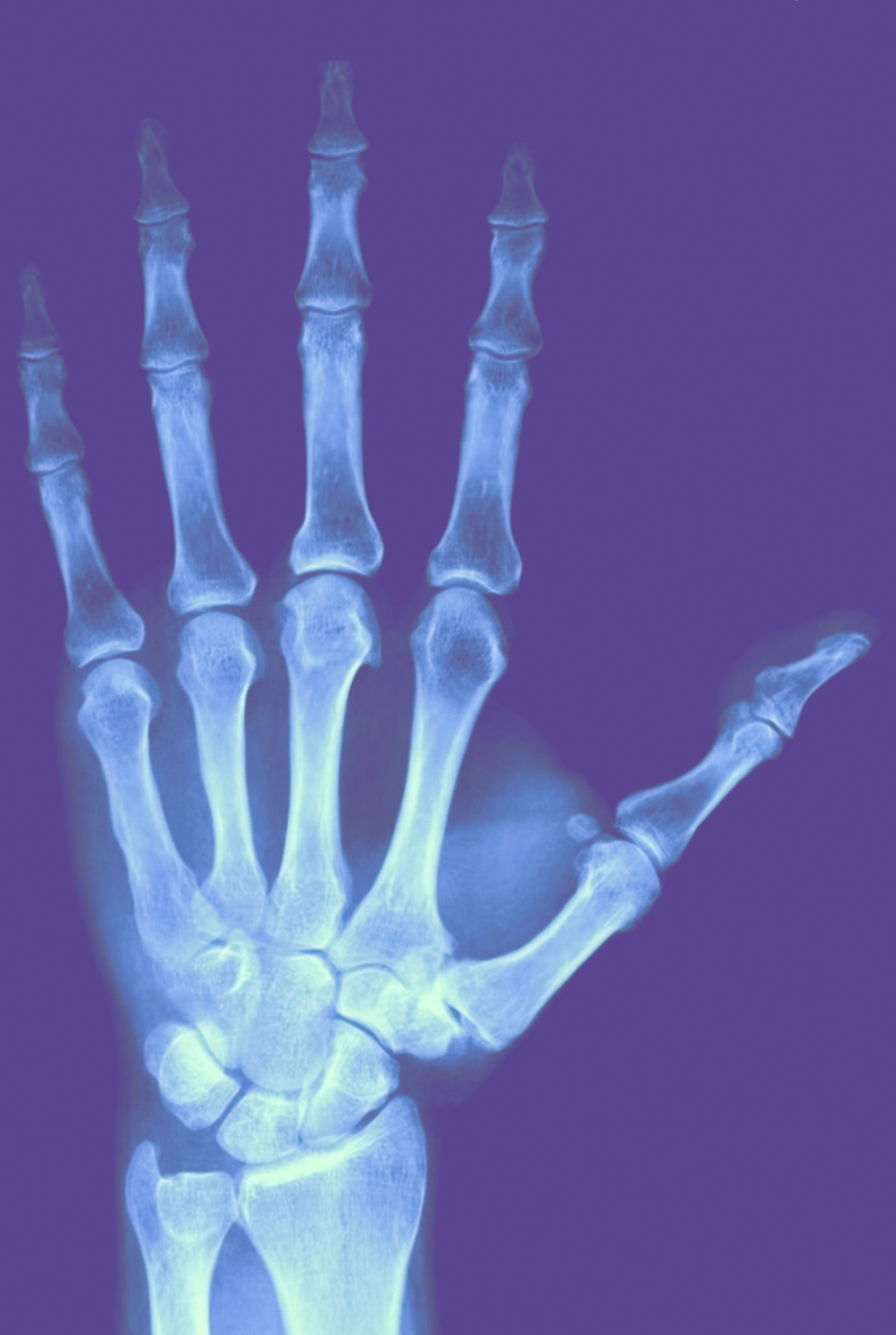 Hand x-ray photo